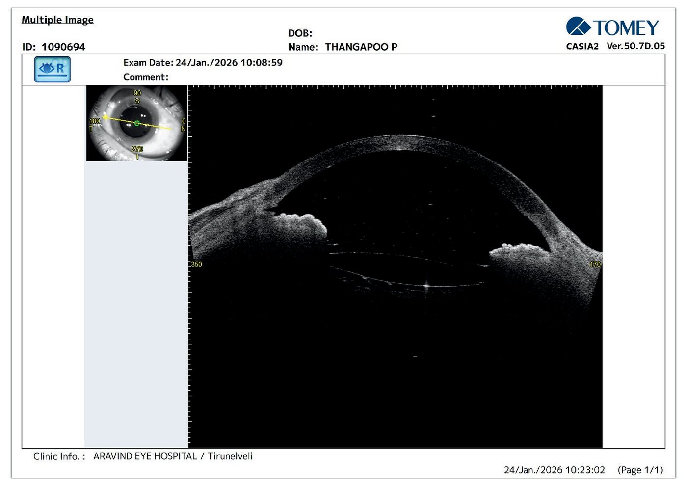 AS-OCT (CASIA TOMEY 2) showing cleft after Dev Dual Hook